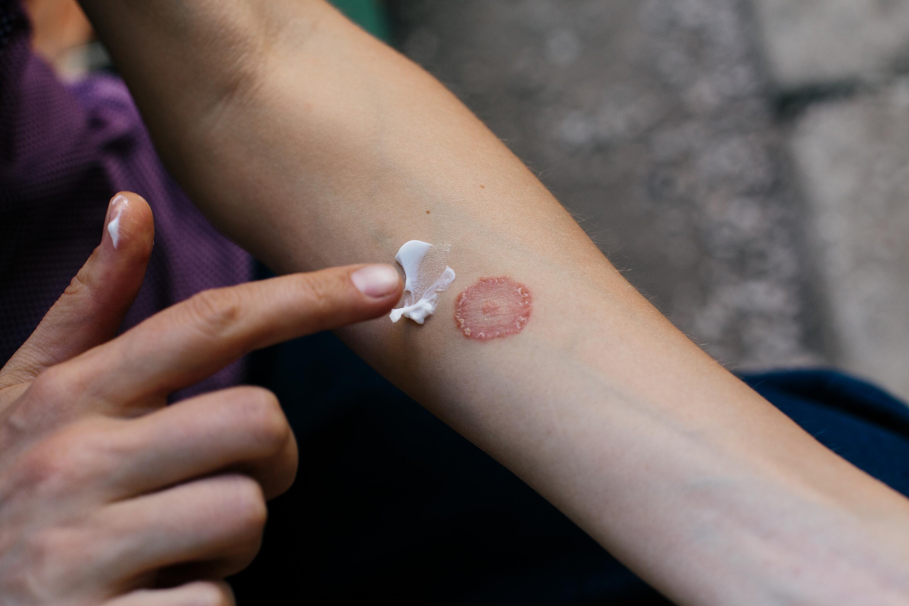 eczema-micosis cutáneas-dermatofitos